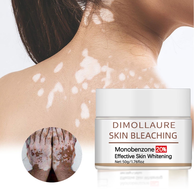 Dimollaure Monobenzone Body Whitening Cream Bleaching Vitiligo